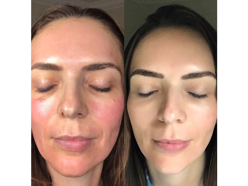 CO2Lift Pro Carboxy Gel Treatment